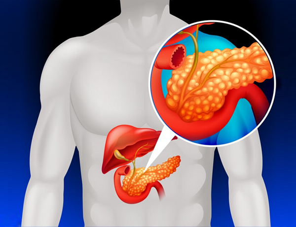 Pancreas Transplantation
