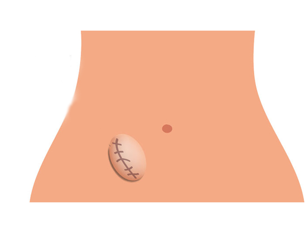 Incisional Hernia