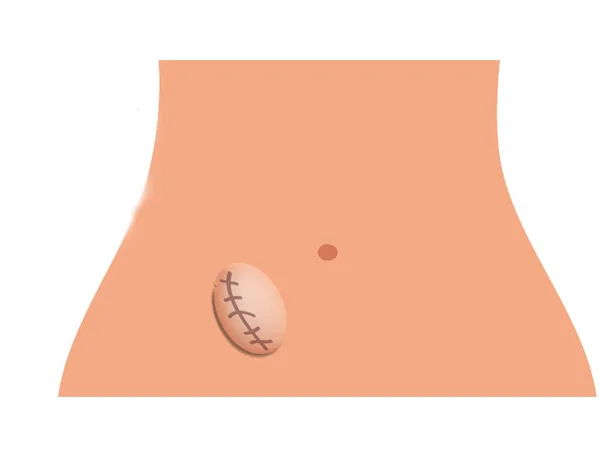 Incisional Hernia