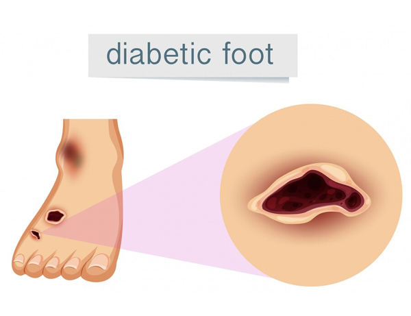 Diabetic Foot Treatment